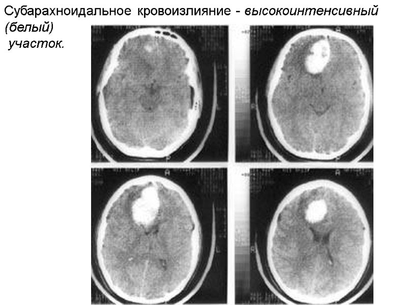 Субарахноидальное кровоизлияние - высокоинтенсивный (белый)  участок.